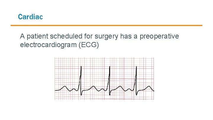 Cardiac A patient scheduled for surgery has a preoperative electrocardiogram (ECG) 
