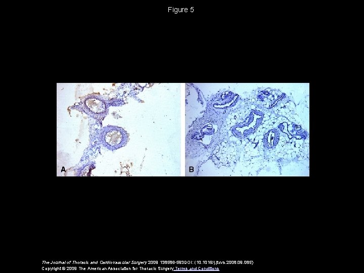 Figure 5 The Journal of Thoracic and Cardiovascular Surgery 2009 138586 -593 DOI: (10.