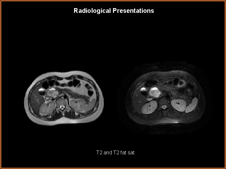 Radiological Presentations T 2 and T 2 fat sat 