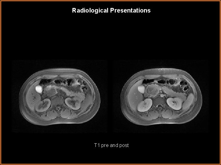 Radiological Presentations T 1 pre and post 