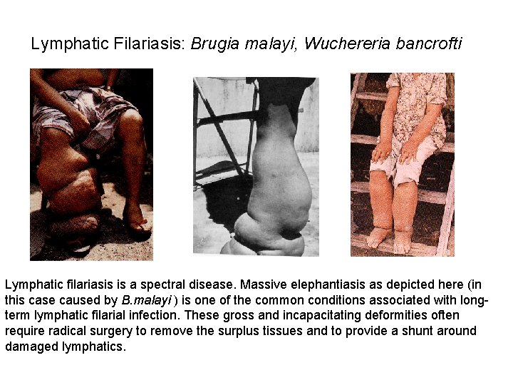 Lymphatic Filariasis: Brugia malayi, Wuchereria bancrofti Lymphatic filariasis is a spectral disease. Massive elephantiasis