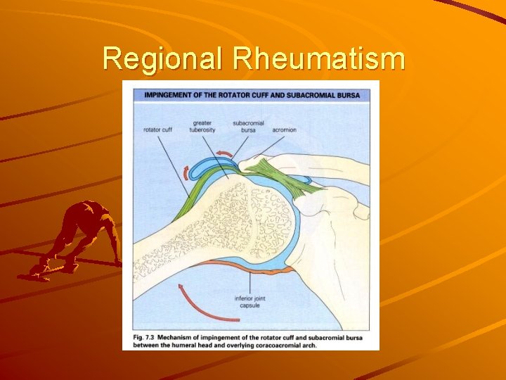 Regional Rheumatism 