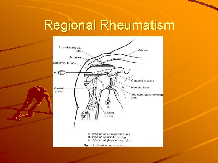 Regional Rheumatism 