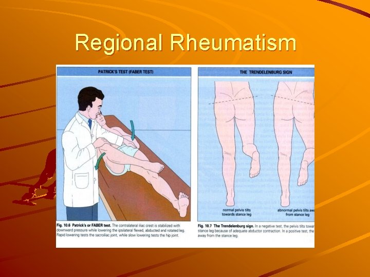 Regional Rheumatism 