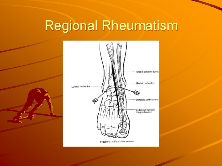 Regional Rheumatism 