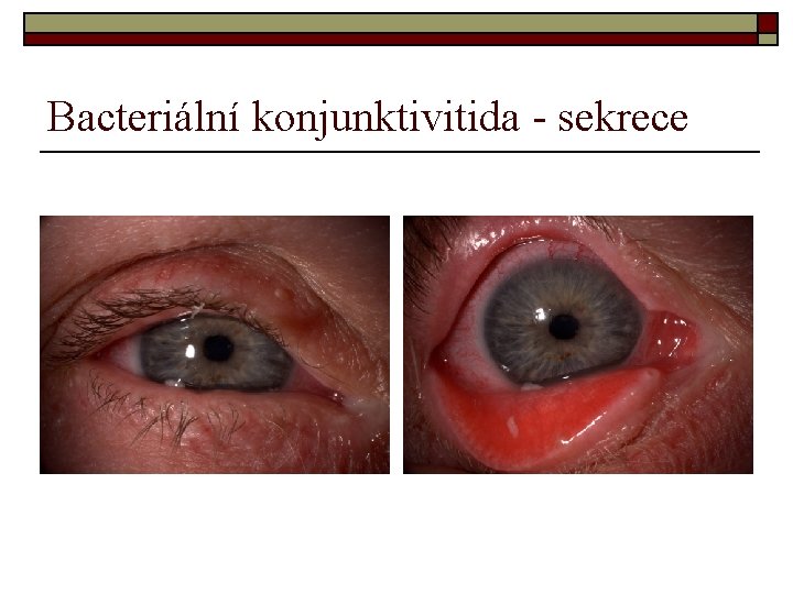 Bacteriální konjunktivitida - sekrece Bacteriální konjunktivitida - sekrece