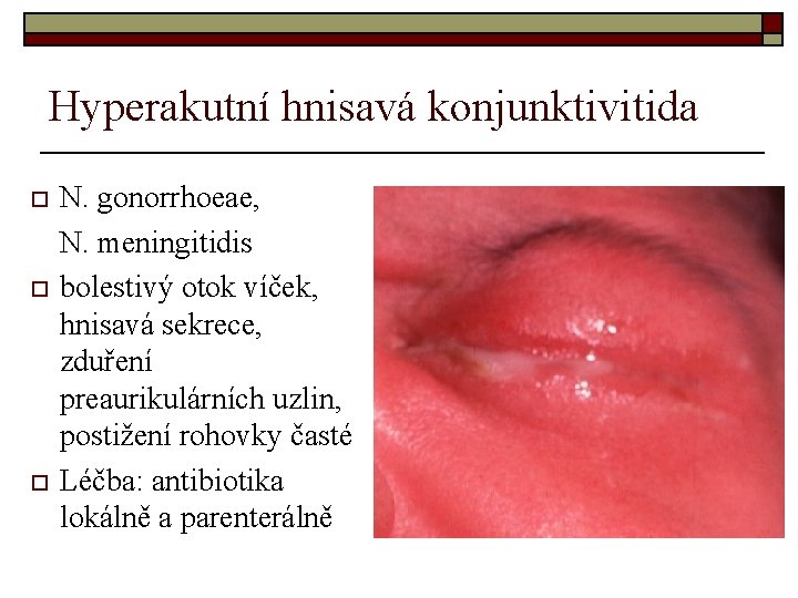 Hyperakutní hnisavá konjunktivitida o o o N. gonorrhoeae, N. meningitidis bolestivý otok víček, hnisavá Hyperakutní hnisavá konjunktivitida o o o N. gonorrhoeae, N. meningitidis bolestivý otok víček, hnisavá