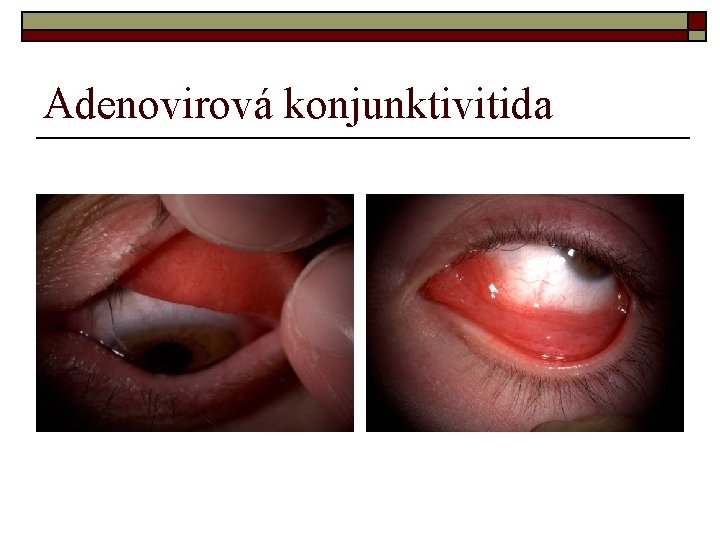 Adenovirová konjunktivitida Adenovirová konjunktivitida
