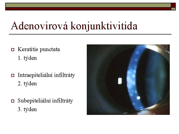 Adenovirová konjunktivitida o Keratitis punctata 1. týden o Intraepiteliální infiltráty 2. týden o Subepiteliální Adenovirová konjunktivitida o Keratitis punctata 1. týden o Intraepiteliální infiltráty 2. týden o Subepiteliální