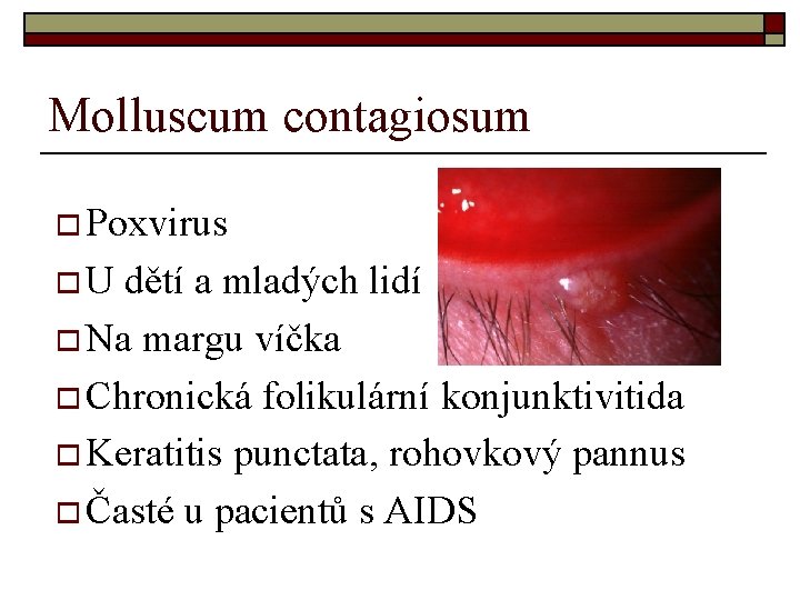 Molluscum contagiosum o Poxvirus o. U dětí a mladých lidí o Na margu víčka Molluscum contagiosum o Poxvirus o. U dětí a mladých lidí o Na margu víčka