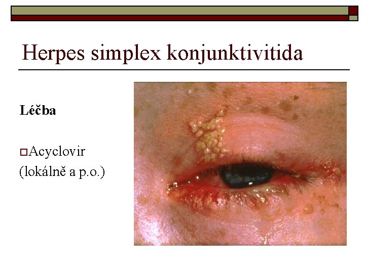 Herpes simplex konjunktivitida Léčba o. Acyclovir (lokálně a p. o. ) Herpes simplex konjunktivitida Léčba o. Acyclovir (lokálně a p. o. )