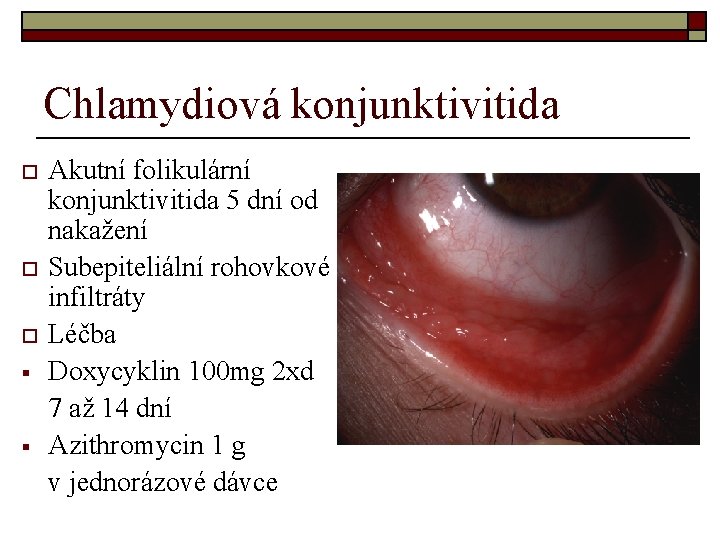 Chlamydiová konjunktivitida o o o § § Akutní folikulární konjunktivitida 5 dní od nakažení Chlamydiová konjunktivitida o o o § § Akutní folikulární konjunktivitida 5 dní od nakažení