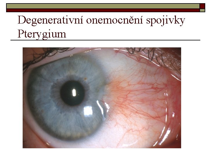 Degenerativní onemocnění spojivky Pterygium Degenerativní onemocnění spojivky Pterygium