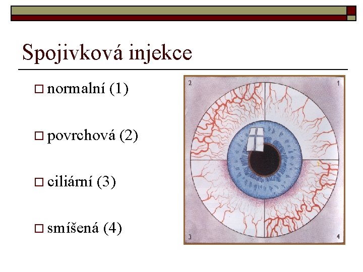 Spojivková injekce o normalní (1) o povrchová o ciliární (2) (3) o smíšená (4) Spojivková injekce o normalní (1) o povrchová o ciliární (2) (3) o smíšená (4)