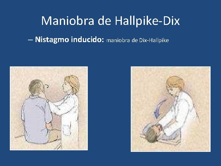 Maniobra de Hallpike-Dix – Nistagmo inducido: maniobra de Dix-Hallpike Maniobra de Hallpike-Dix – Nistagmo inducido: maniobra de Dix-Hallpike