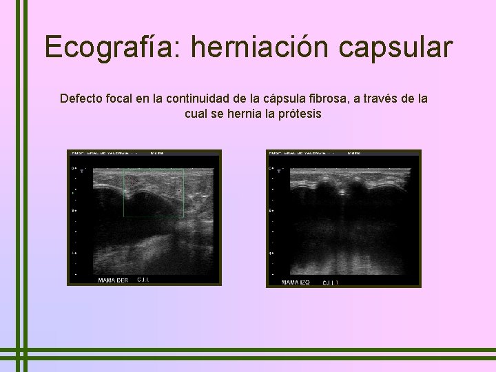 Ecografía: herniación capsular Defecto focal en la continuidad de la cápsula fibrosa, a través