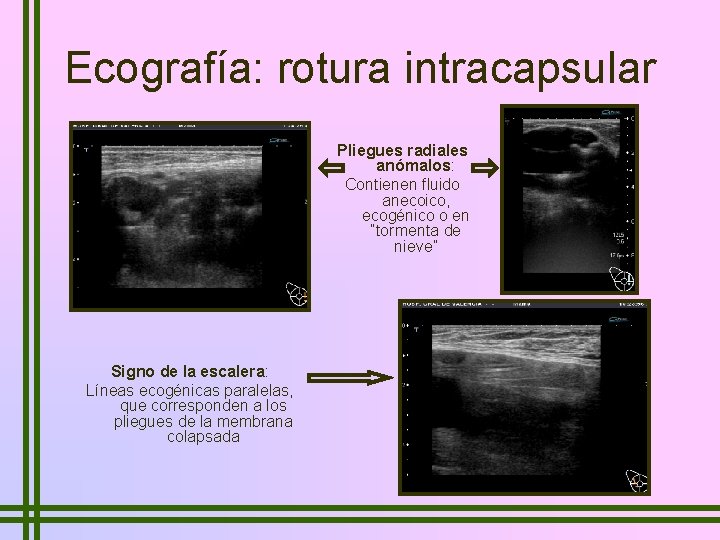 Ecografía: rotura intracapsular Pliegues radiales anómalos: Contienen fluido anecoico, ecogénico o en “tormenta de