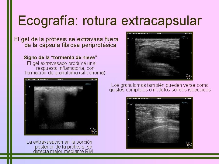 Ecografía: rotura extracapsular El gel de la prótesis se extravasa fuera de la cápsula