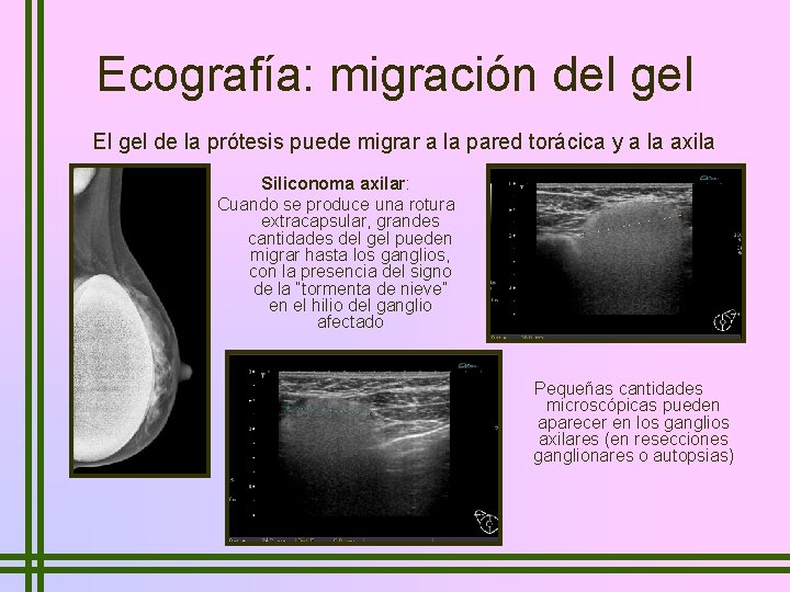 Ecografía: migración del gel El gel de la prótesis puede migrar a la pared