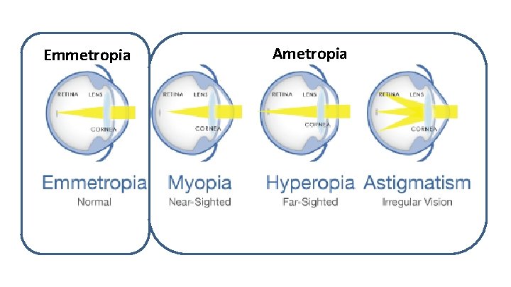Képek a myopia hyperopiaról - fashionterminal.hu