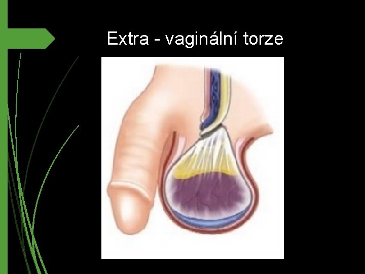 Extra - vaginální torze 