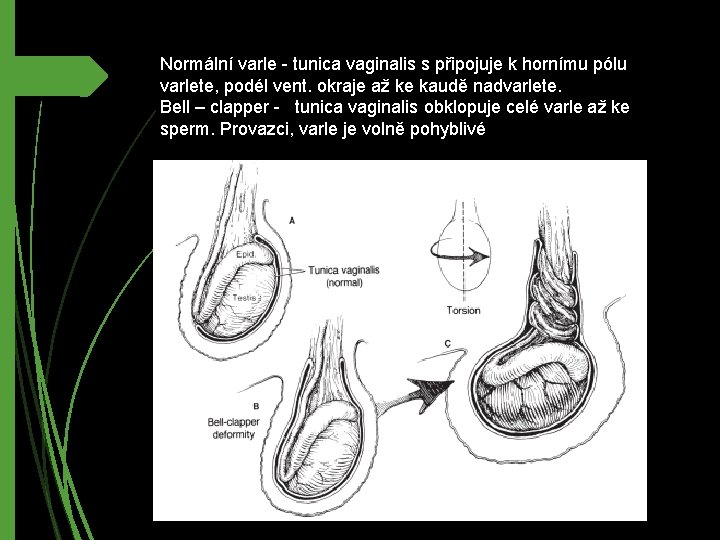 Normální varle - tunica vaginalis s připojuje k hornímu pólu varlete, podél vent. okraje