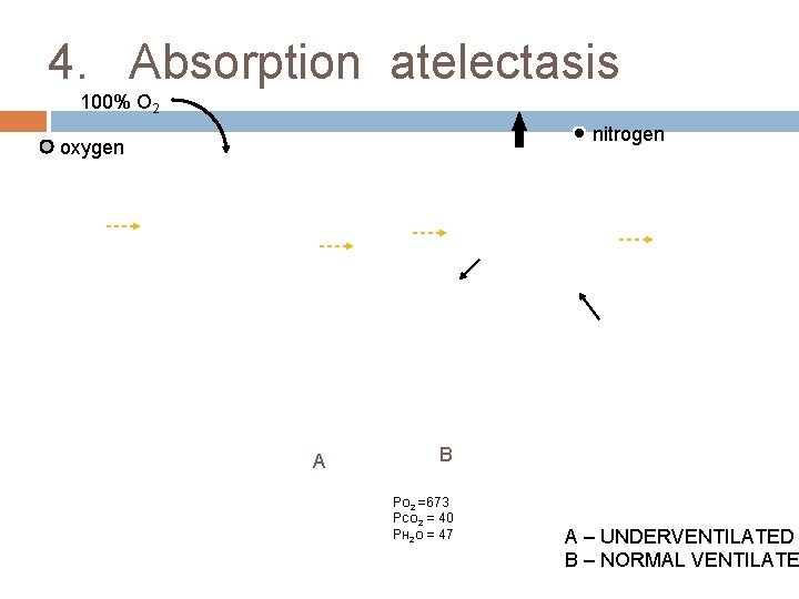 4. Absorption atelectasis 100% O 2 nitrogen oxygen A B PO 2 =673 PCO