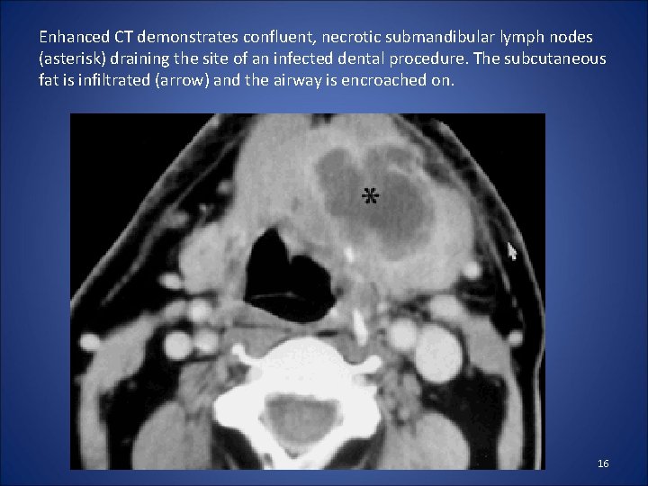 Enhanced CT demonstrates confluent, necrotic submandibular lymph nodes (asterisk) draining the site of an