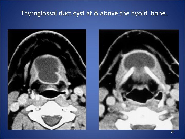 Thyroglossal duct cyst at & above the hyoid bone. 24 