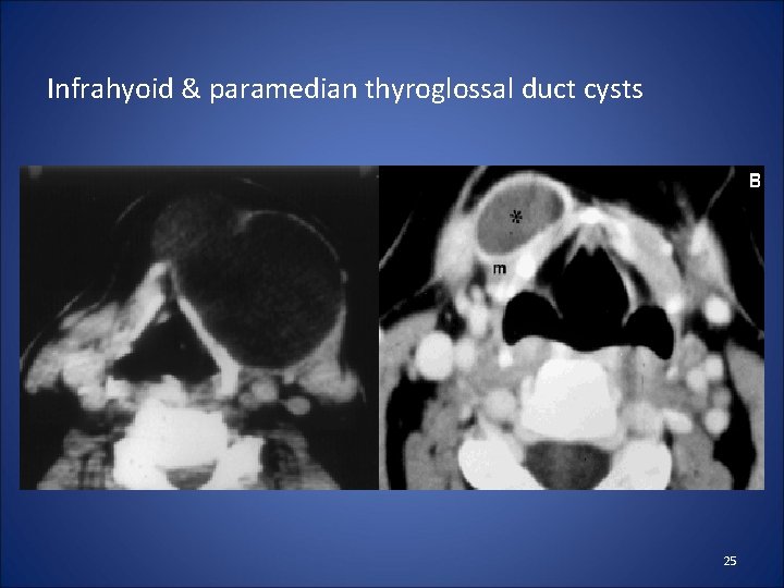 Infrahyoid & paramedian thyroglossal duct cysts 25 