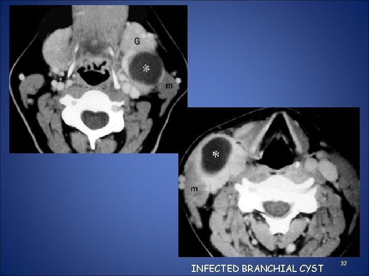 INFECTED BRANCHIAL CYST 32 