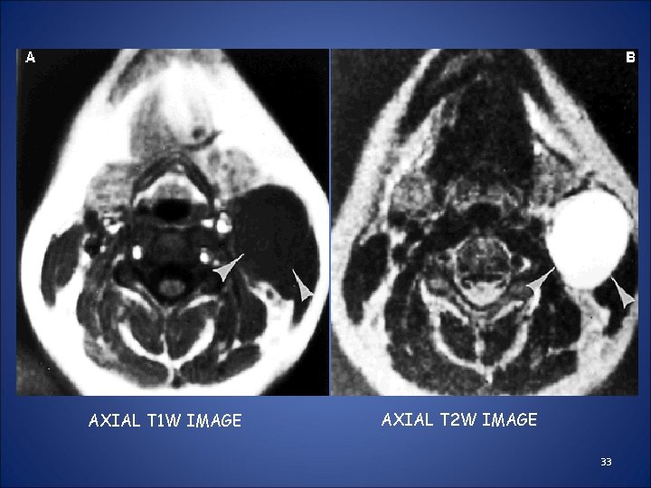 AXIAL T 1 W IMAGE AXIAL T 2 W IMAGE 33 