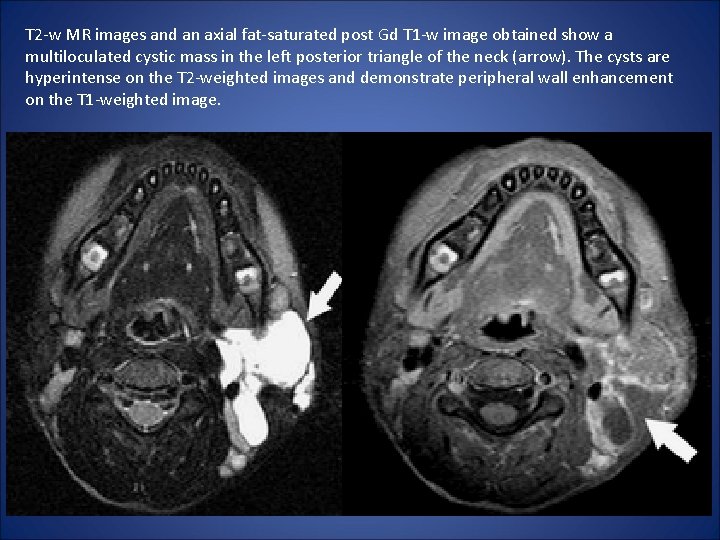 T 2 -w MR images and an axial fat-saturated post Gd T 1 -w