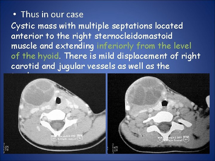  • Thus in our case Cystic mass with multiple septations located anterior to