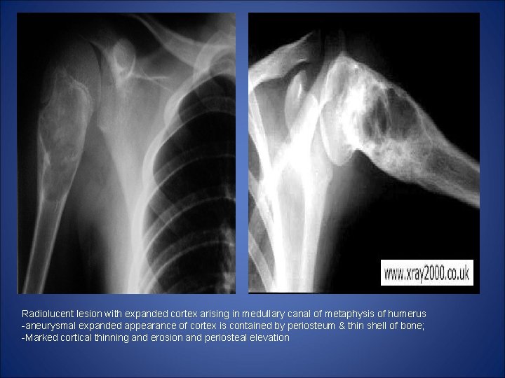 Radiolucent lesion with expanded cortex arising in medullary canal of metaphysis of humerus -aneurysmal