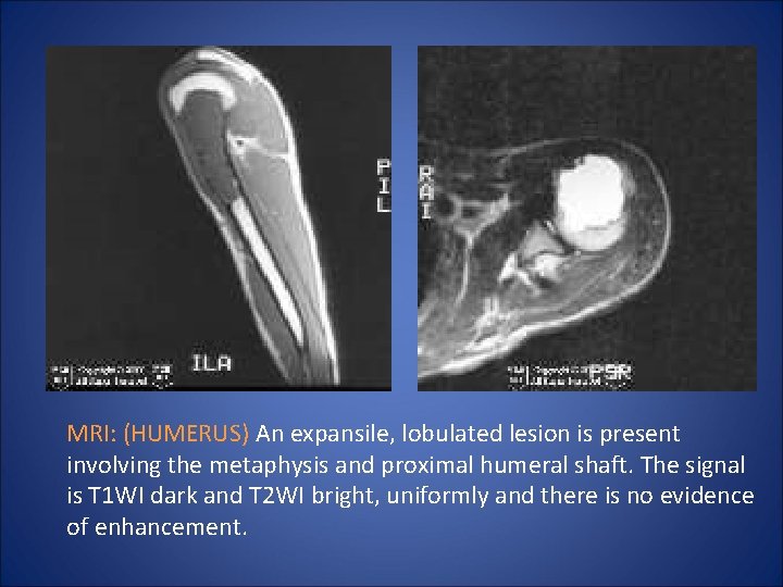 MRI: (HUMERUS) An expansile, lobulated lesion is present involving the metaphysis and proximal humeral