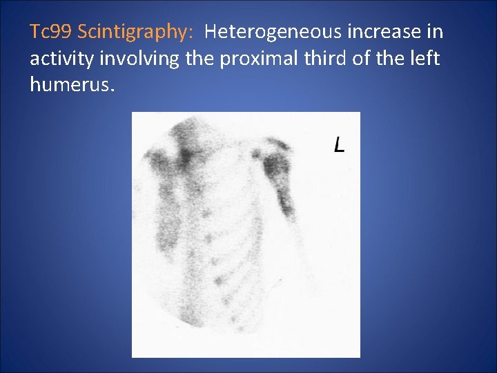 Tc 99 Scintigraphy: Heterogeneous increase in activity involving the proximal third of the left