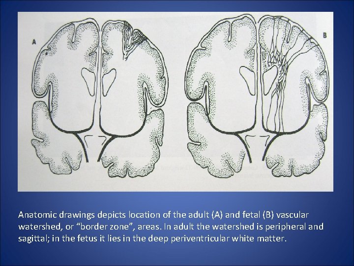 Anatomic drawings depicts location of the adult (A) and fetal (B) vascular watershed, or