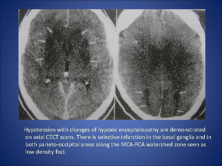  Hypotension with changes of hypoxic encephalopathy are demonstrated on axial CECT scans. There