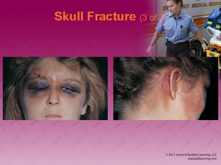 Skull Fracture (3 of 7) 