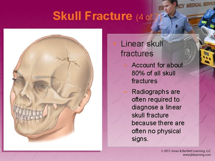 Skull Fracture (4 of 7) • Linear skull fractures – Account for about 80%