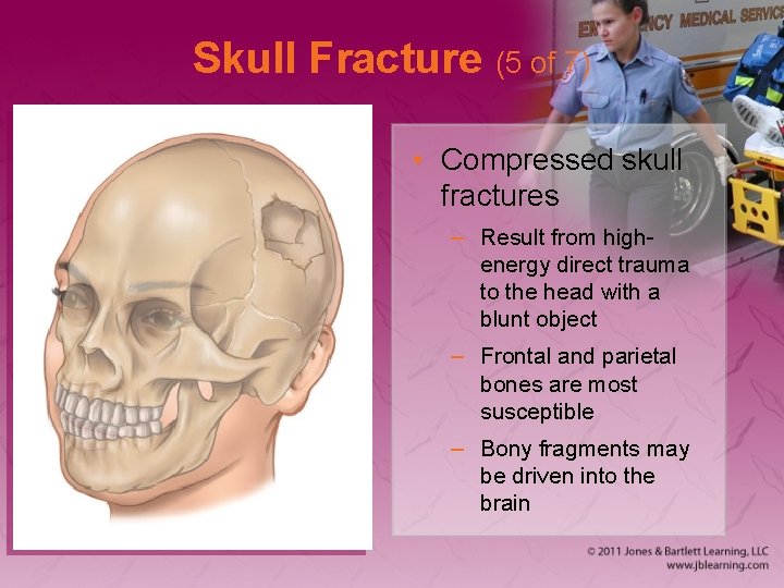 Skull Fracture (5 of 7) • Compressed skull fractures – Result from highenergy direct