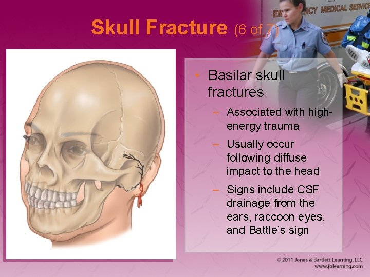 Skull Fracture (6 of 7) • Basilar skull fractures – Associated with highenergy trauma