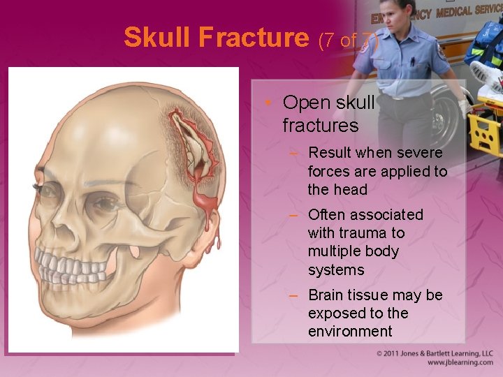 Skull Fracture (7 of 7) • Open skull fractures – Result when severe forces