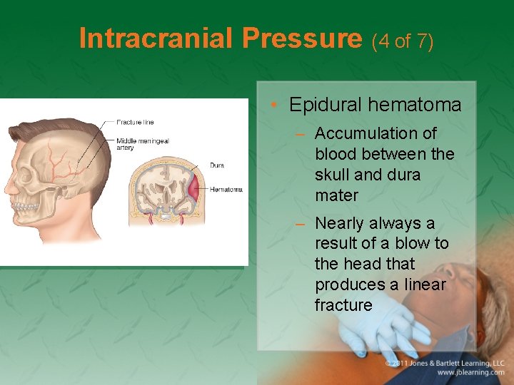 Intracranial Pressure (4 of 7) • Epidural hematoma – Accumulation of blood between the