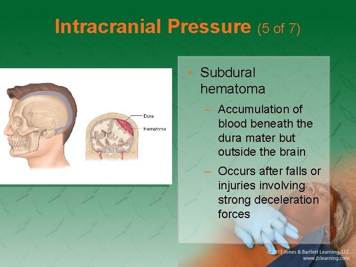 Intracranial Pressure (5 of 7) • Subdural hematoma – Accumulation of blood beneath the