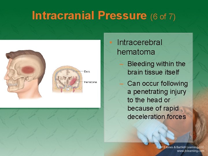 Intracranial Pressure (6 of 7) • Intracerebral hematoma – Bleeding within the brain tissue