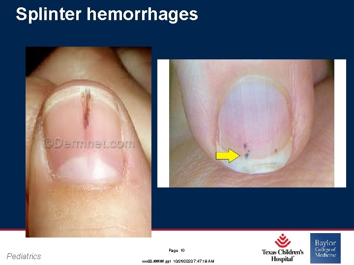 Splinter hemorrhages Pediatrics Page 10 xxx 00. #####. ppt 10/26/2020 7: 47: 18 AM Splinter hemorrhages Pediatrics Page 10 xxx 00. #####. ppt 10/26/2020 7: 47: 18 AM