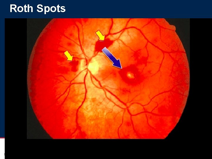 Roth Spots Pediatrics Page 11 xxx 00. #####. ppt 10/26/2020 7: 47: 19 AM Roth Spots Pediatrics Page 11 xxx 00. #####. ppt 10/26/2020 7: 47: 19 AM