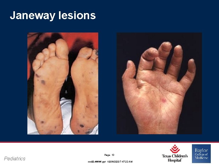 Janeway lesions Pediatrics Page 13 xxx 00. #####. ppt 10/26/2020 7: 47: 22 AM Janeway lesions Pediatrics Page 13 xxx 00. #####. ppt 10/26/2020 7: 47: 22 AM